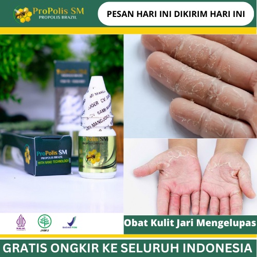 Jual Obat Kulit Jari Mengelupas Obat Jari Tangan Kering Telapak