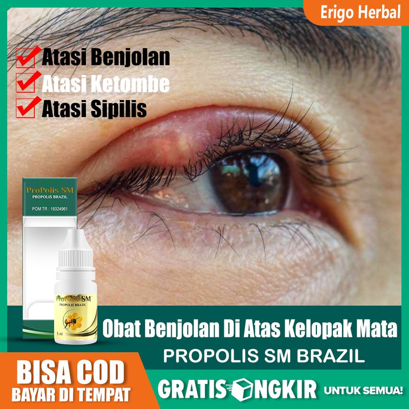 Jual Obat Sakit Benjolan Di Atas Kelopak Mata Kalazion Bintitan