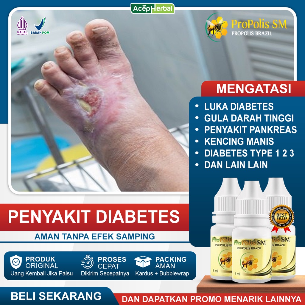 Jual Obat Pengering Luka Diabetes Basah Dan Kering Penurun Gula Darah