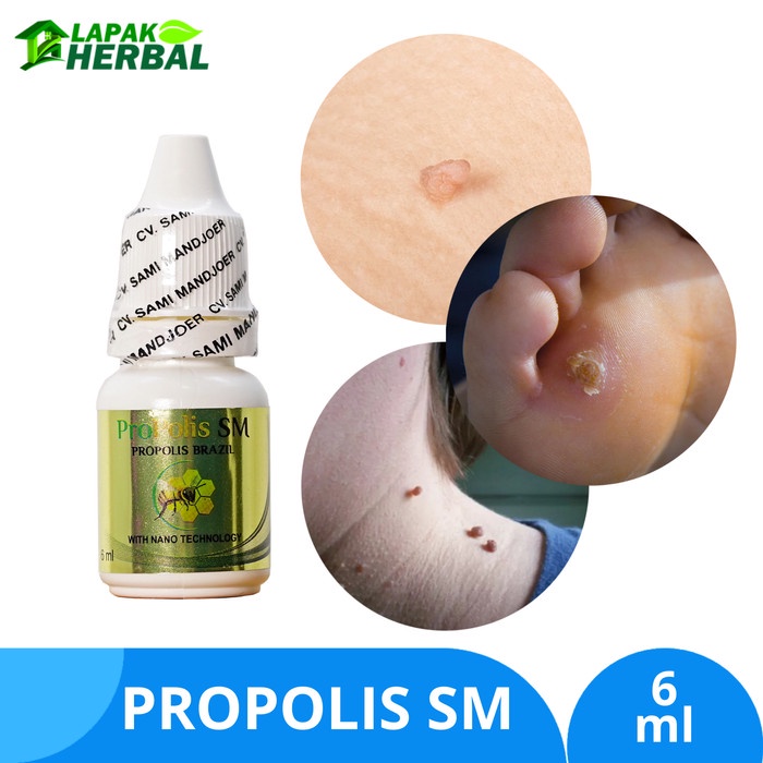 Jual Obat Kutil Leher Penghilang Skin Tag Papiloma Mata Ikan Propolis