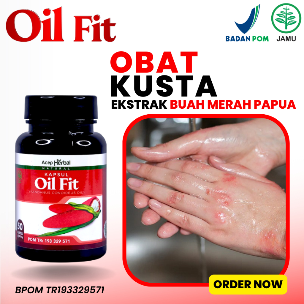 Jual Obat Kusta Basah Dan Kering Penyakit Kulit Lepra Morbus Hansen