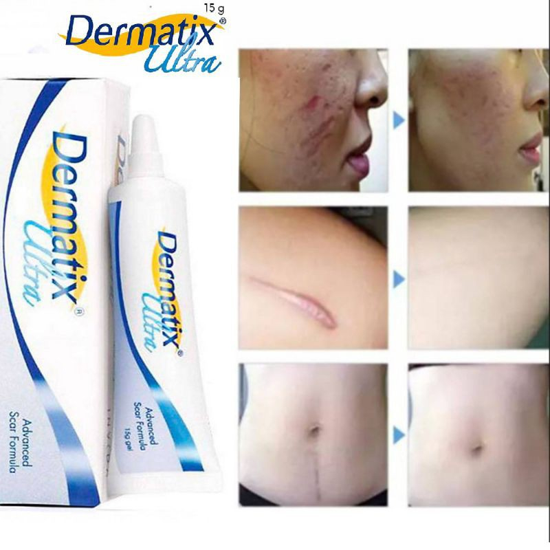 Jual Dermatix Ultra Gel Gr Penghilang Bekas Luka Hilang Cream Keloid