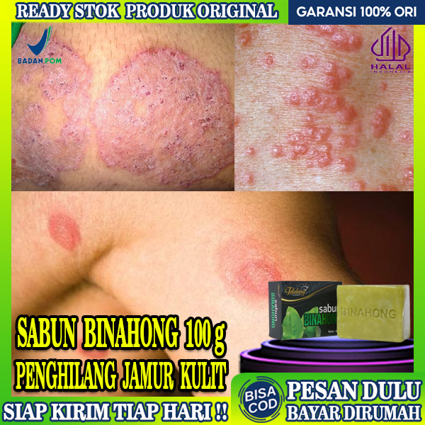 Jual Tetulung Sabun Binahong Obat Jamur Kulit Obat Gatal Jamur Kurap