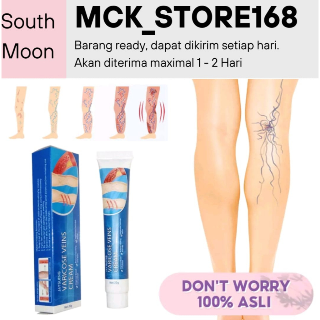 Jual South Moon Varicose Veins Cream Krim Spider Vein Meningkatkan