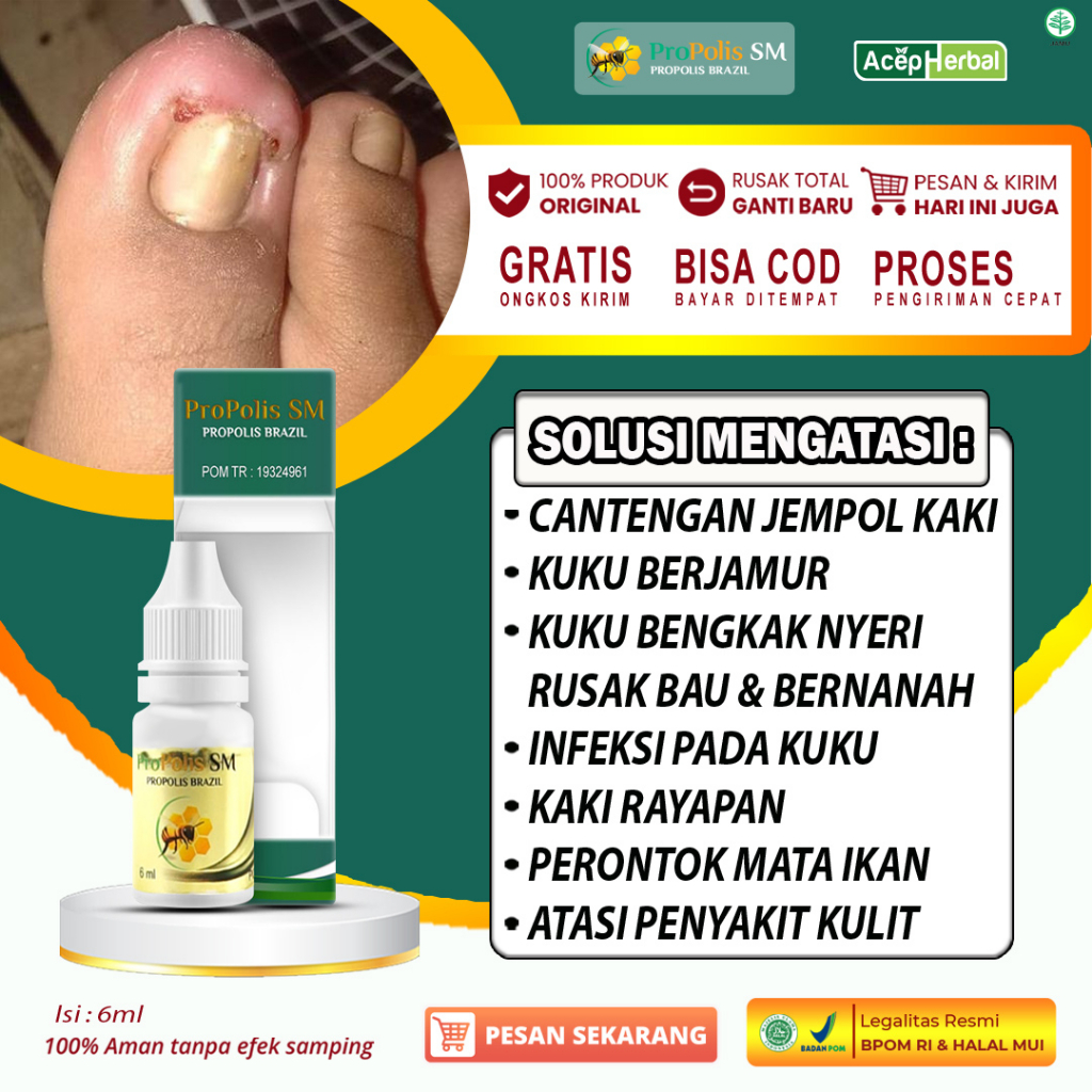 Jual Obat Tetes Cantengan Kuku Kaki Rusak Jamuran Bernanah Bau Kaki