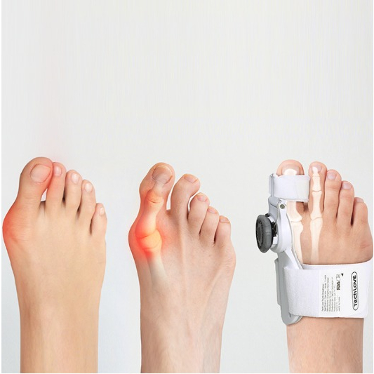 Jual Alat Korektor Pelurus Jempol Kaki Bunion Hallux Valgus Dengan