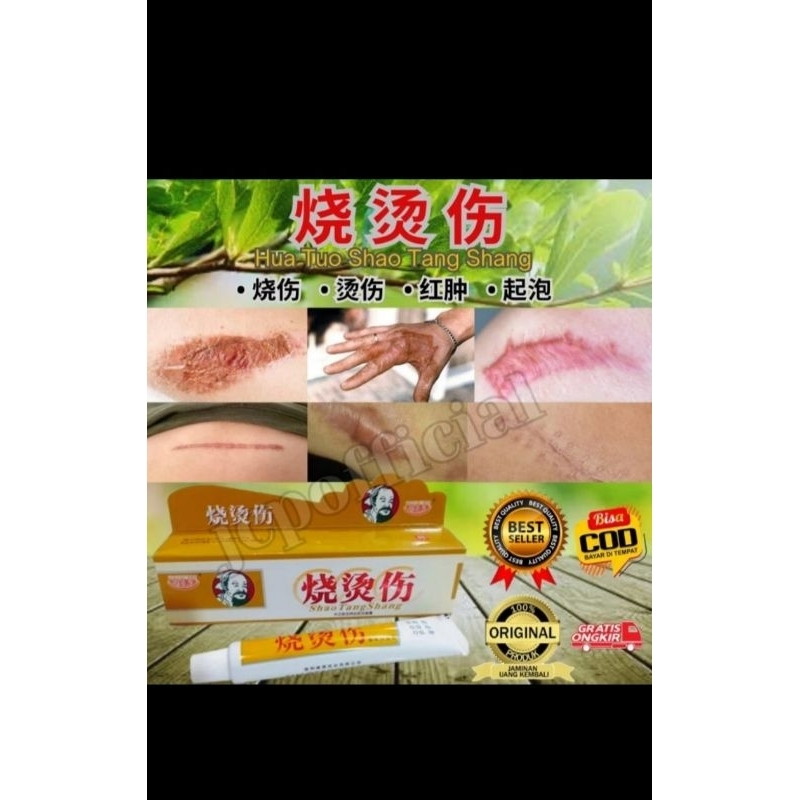 Jual SHAO TANG SHANG Hua Tuo Obat Luka Bakar Melepuh Shopee Indonesia