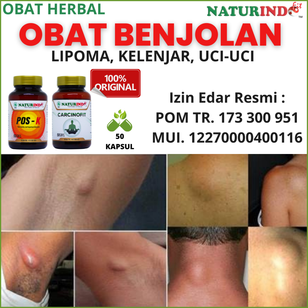 Jual Obat Benjolan Herbal Lipoma Kelenjar Di Leher Ketiak Payudara