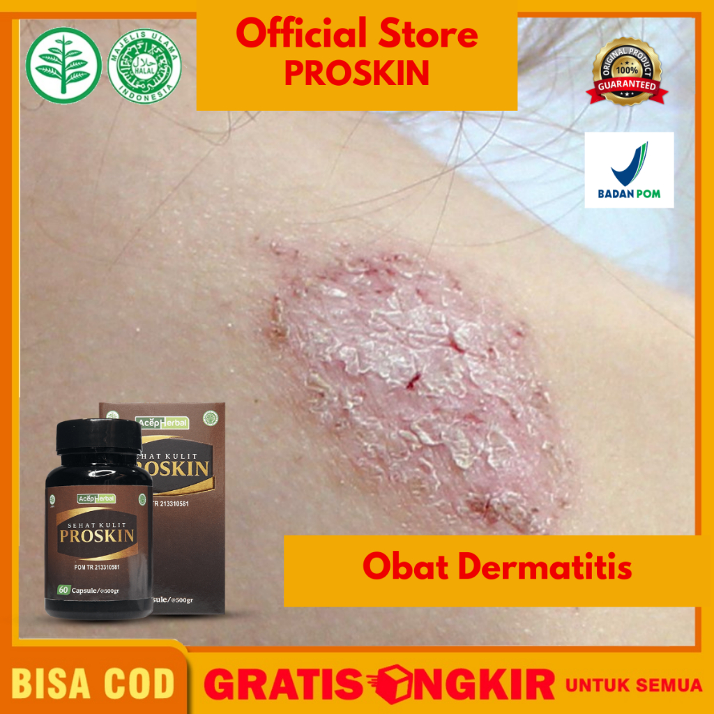 Jual Obat Dermatitis Menahun Scabies Budug Di Tangan Dan Kaki Dan