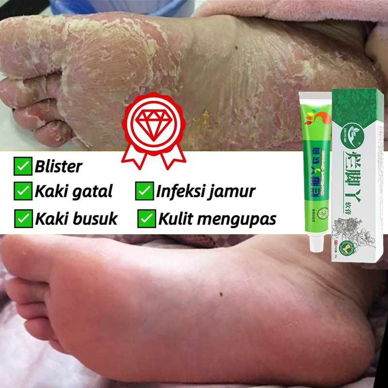 Jual Obat Kaki Rayapan Obat Kapalan Kaki Tumitku Obat Kaki Pecah