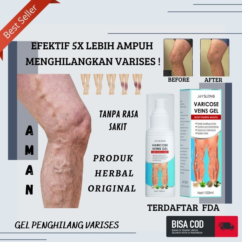 Jual Spray Penghilang Varises Kaki Farises Ampuh Varicose Veins