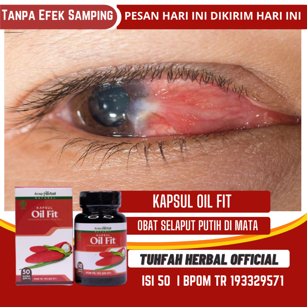 Jual Obat Mata Berlemak Penyakit Pterigium Glukoma Obat Hilangkan