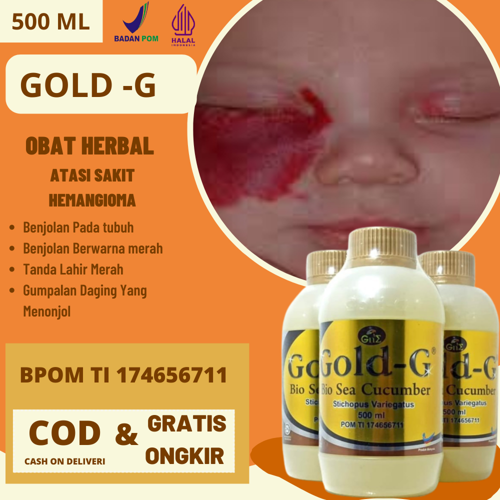 Jual Obat Hemangioma Obat Oles Alami Penghilang Hemangioma Tanda Lahir