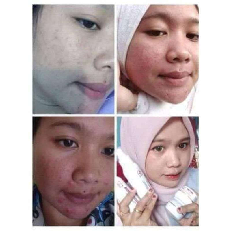 Jual Rk Glow Acne Series Shopee Indonesia