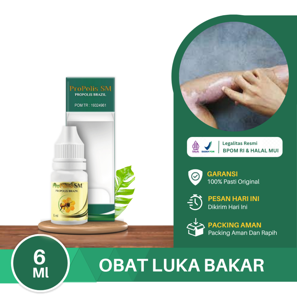 Jual Obat Pengering Luka Bakar Kena Minyak Panas Luka Air Panas