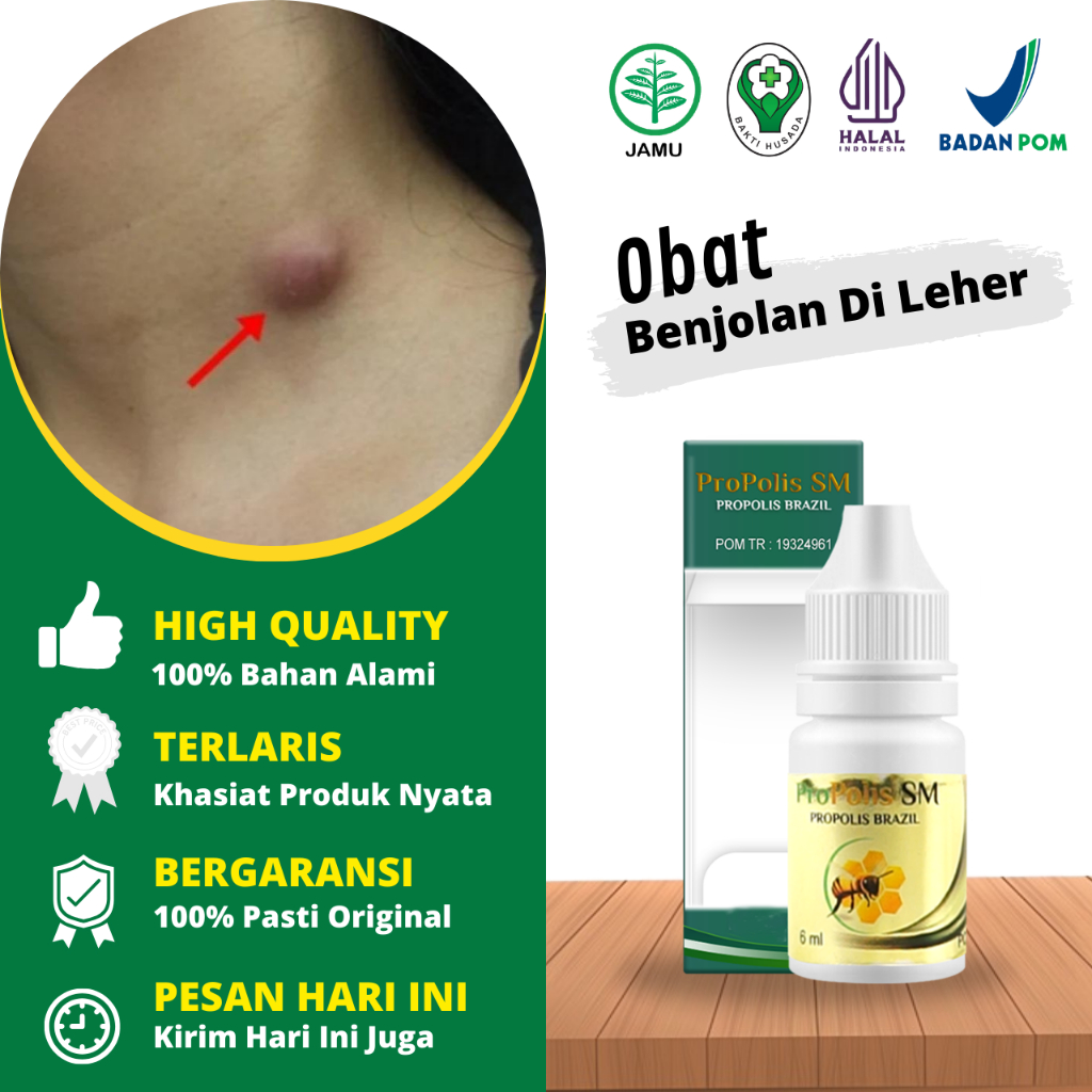 Jual Obat Kelenjar Getah Bening Obat Limfoma Obat Bengkak Di Leher