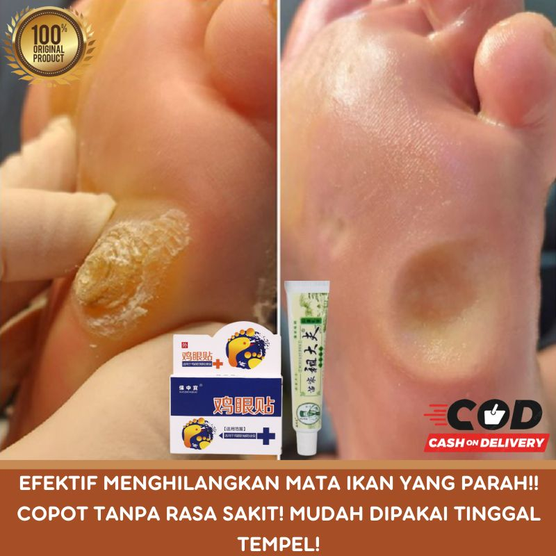 Jual Obat Untuk Kutil Mata Ikan Kapalan Di Kaki Tangan Ampuh Shopee