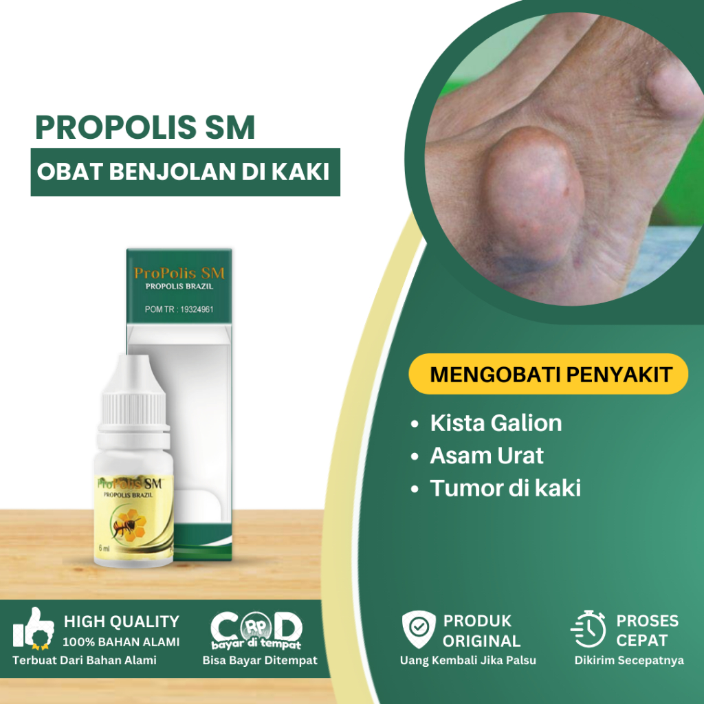 Jual Obat Benjolan Di Kaki Penghilang Kista Galion Di Kaki Obat Asam