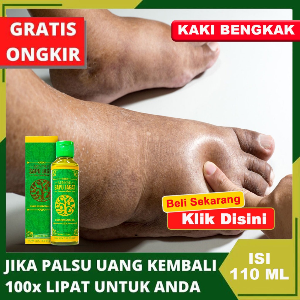 Jual Obat Alami Kaki Bengkak Obat Oles Untuk Kaki Bengkak Obat