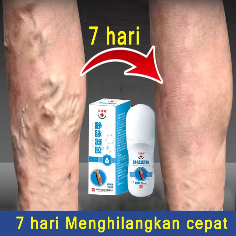 Jual Varicose Veins Obat Varises Di Kaki Dan Betis Ml Vaskulitis Gel