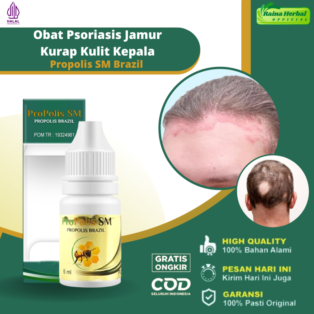 Jual Obat Psoriasis Jamur Kulit Kepala Obat Kurap Kepala Obat Tinea