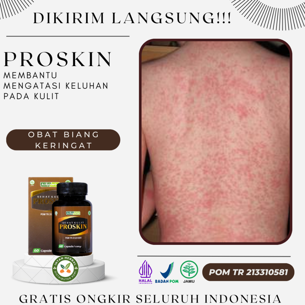 Jual Proskin Original Obat Biang Keringat Gatal Pada Kulit