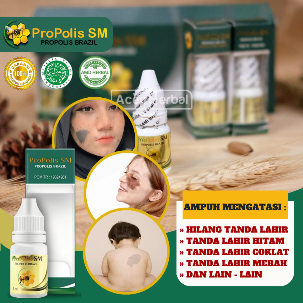 Jual Obat Penghilang Tanda Lahir 100 Alami Obat Oles Dan Konsumsi