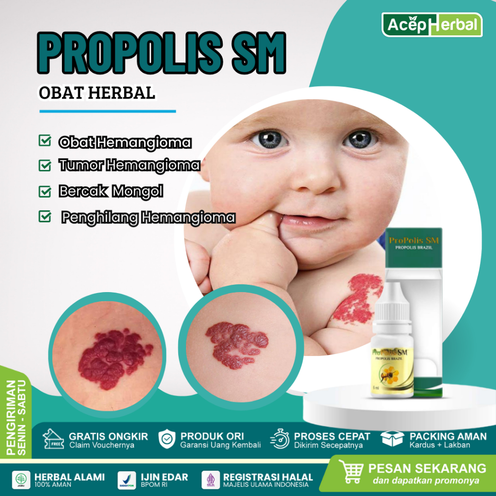 Jual Obat Hemangioma Tumor Hemangioma Benjolan Kemerahan Pada Bayi