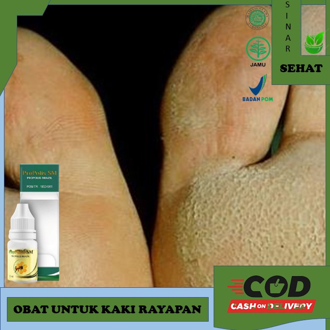 Jual Obat Kaki Rayapan Obat Kaki Rayapan Obat Kaki Rayapan Pitted