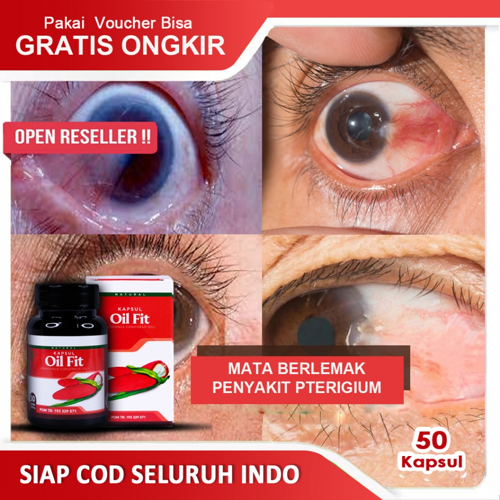 Jual Obat Mata Berlemak Kekuningan Penyakit Pterigium Penghilang