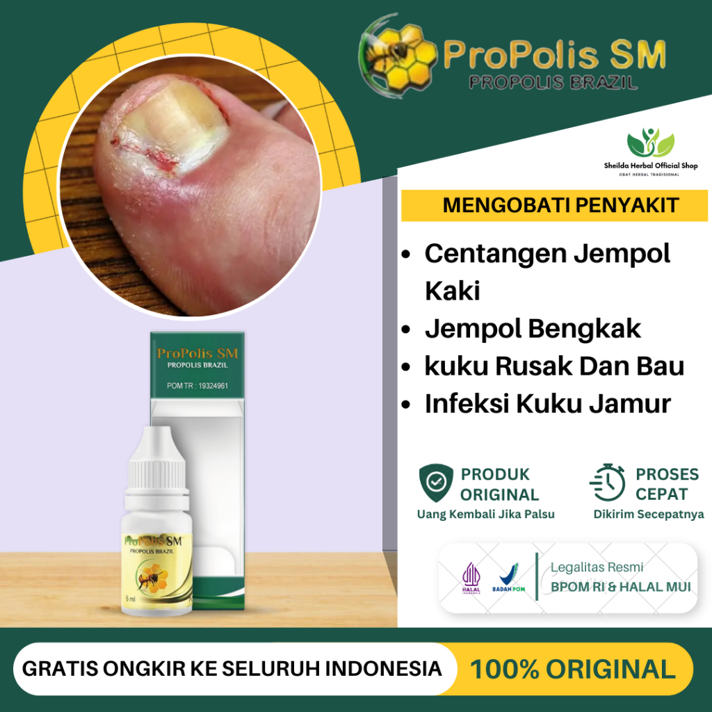 Jual Obat Cantengan Jempol Kaki Kekeongeun Infeksi Kuku Berjamur