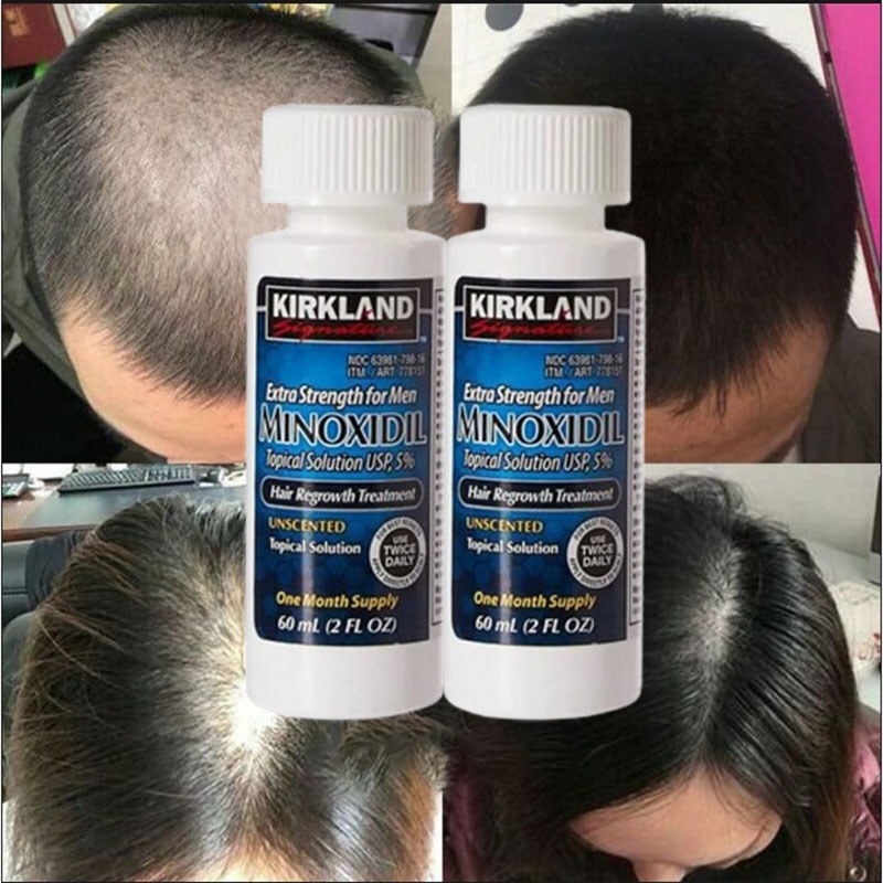 Jual Minoxidil Kirkland Original Minoxidil Penumbuh Rambut