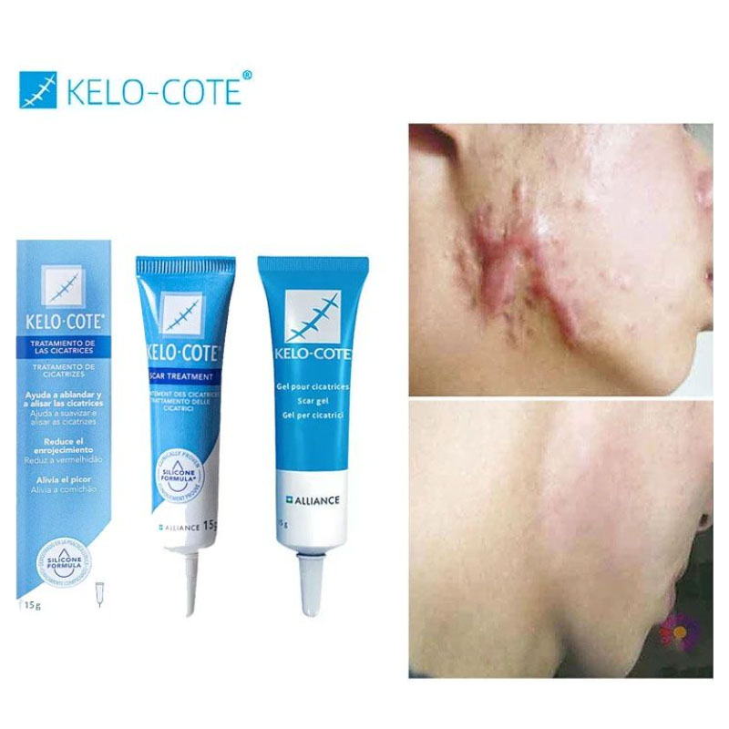 Jual Kelo Cote Scar Gel 15g Salep Obat Penghilang Bekas Luka Keloid