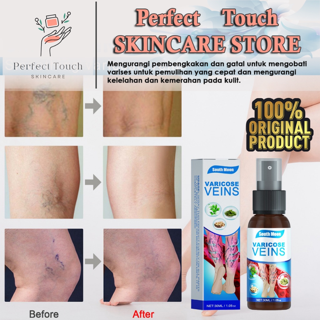 Jual South Moon Varicose Veins Spray Penghilang Urat Menonjol Pada