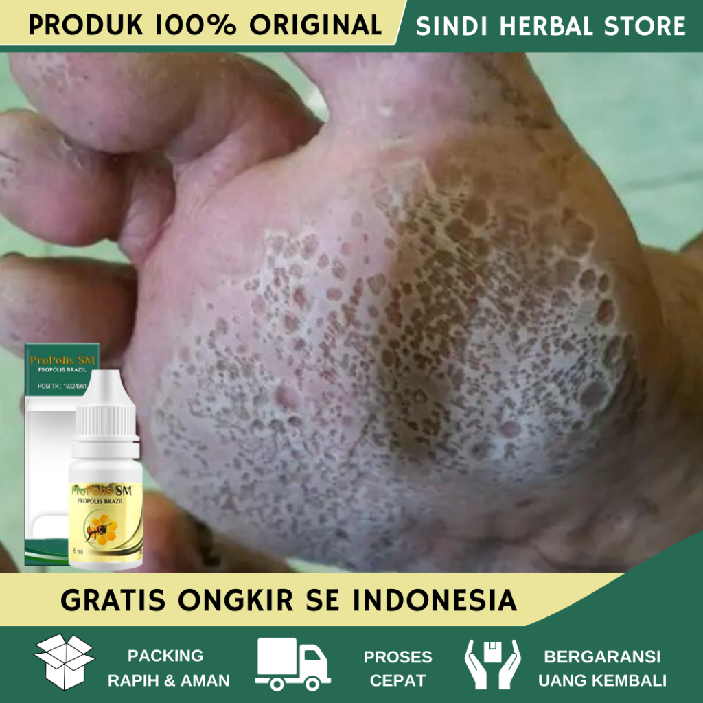 Jual Obat Kaki Rayapan Obat Kaki Pecah2 Kering Parah Obat Penghilang