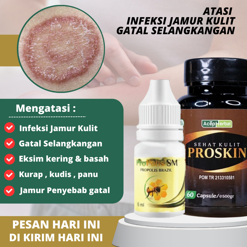 Jual Obat Jamur Dermatitis Psoriasis Eksim Jamur Obat Infeksi Jamur