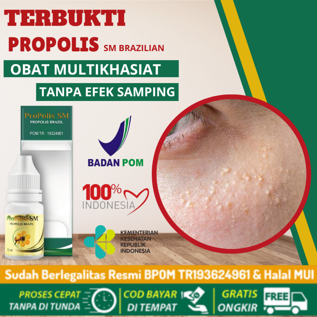 Jual Obat Penghilang Milia Bintik Bintik Putih Di Bawah Mata Jerawat