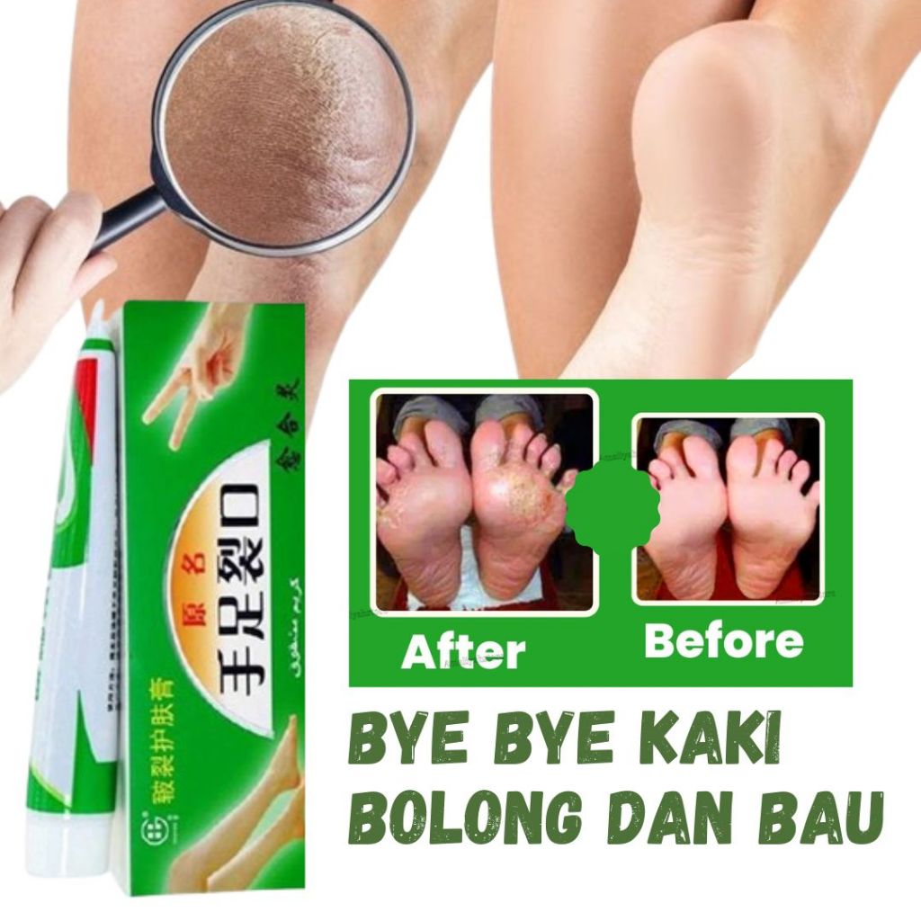 Jual Krim Penghalus Tumit Kaki Rayapan Salep Kaki Rayapan Bolong Bolong