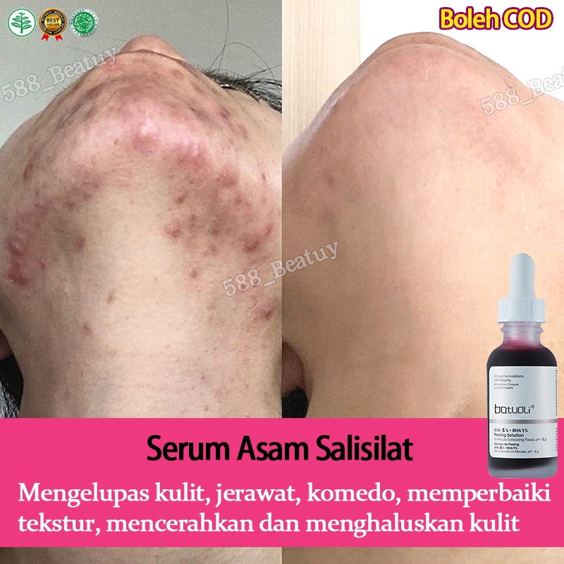 Jual Pore Shrinking Acne Serum Ml Efektif Mengurangi Bekas Jerawat