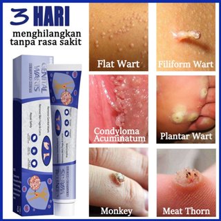 Jual Penghilang Kutil Dan Tahi Lalat Obat Penghilang Kutil Di Wajah