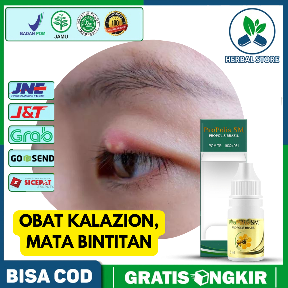 Jual Obat Mata Kalazion Mata Bengkak Bintitan Benjolan Di Kelopak