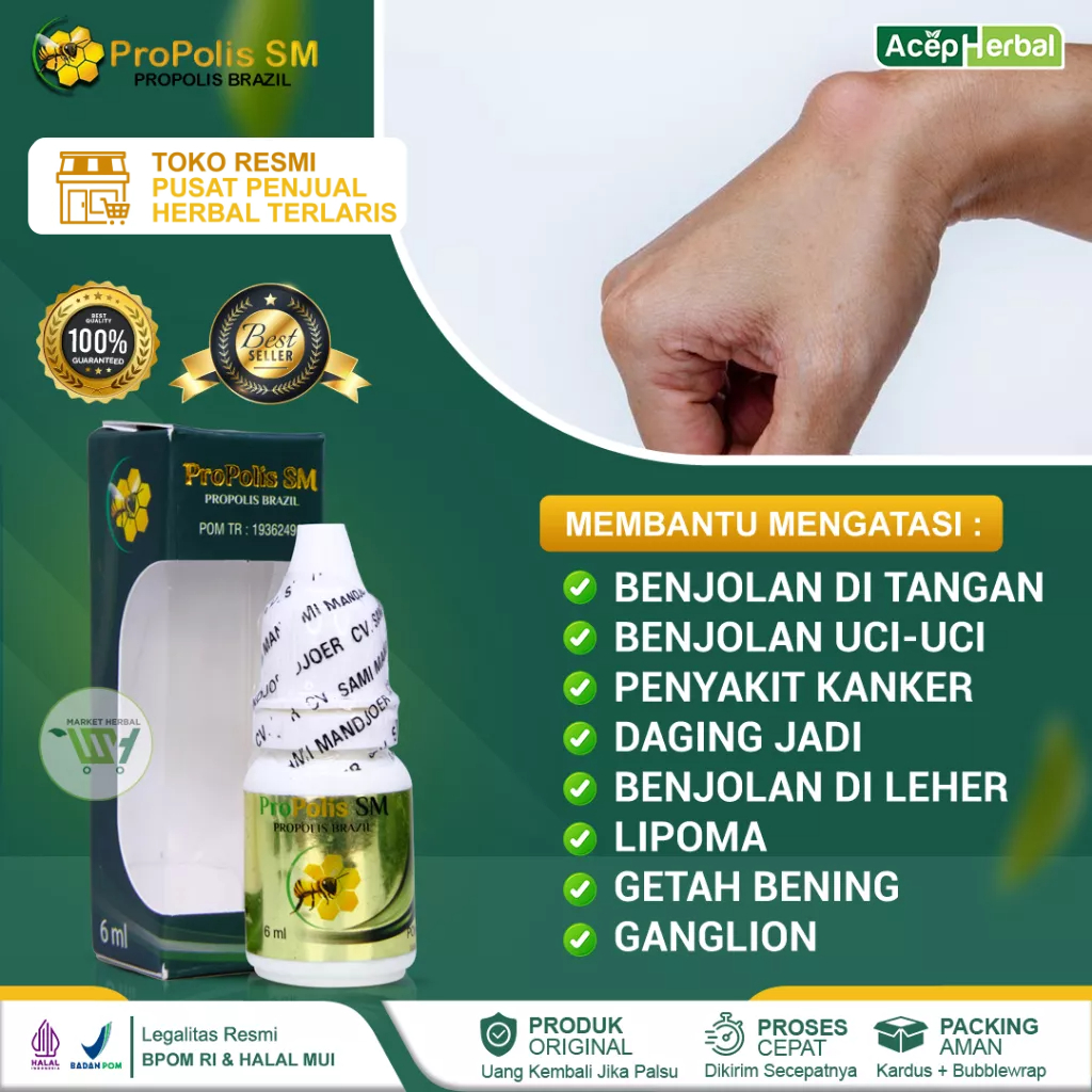 Jual Obat Benjolan Di Tangan Ganglion Tiroid Kelenjar Getah Bening