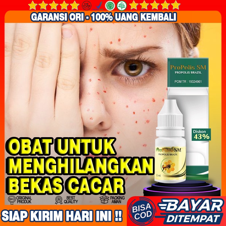 Jual Obat Bekas Cacar Air Penghilang Milia Penghilang Bekas Cacar Di