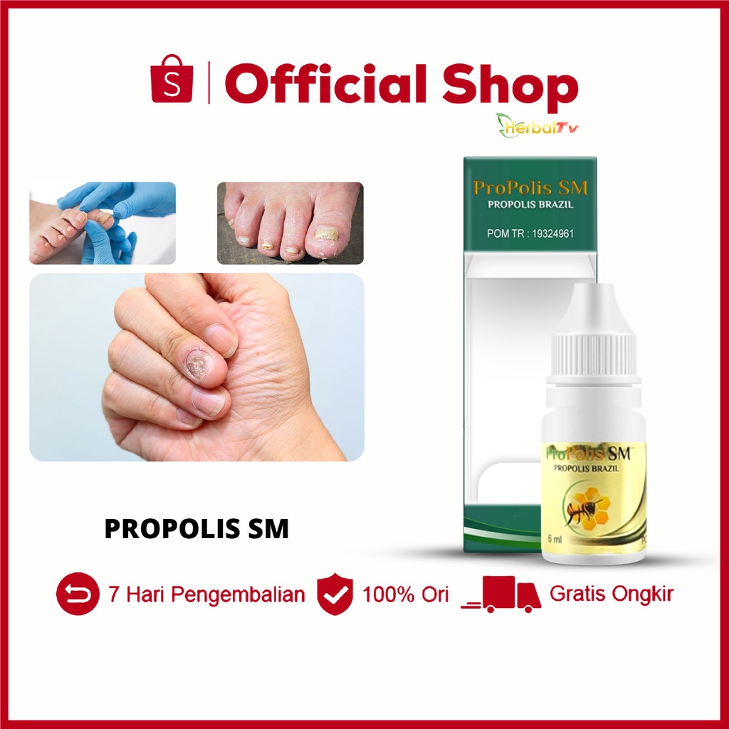 Jual Obat Jamur Kuku Infeksi Kuku Psoriasis Cantengan Kuku Tangan