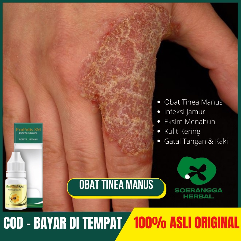 Jual Obat Tinea Manus Infeksi Jamur Eksim Menahun Kulit Kering