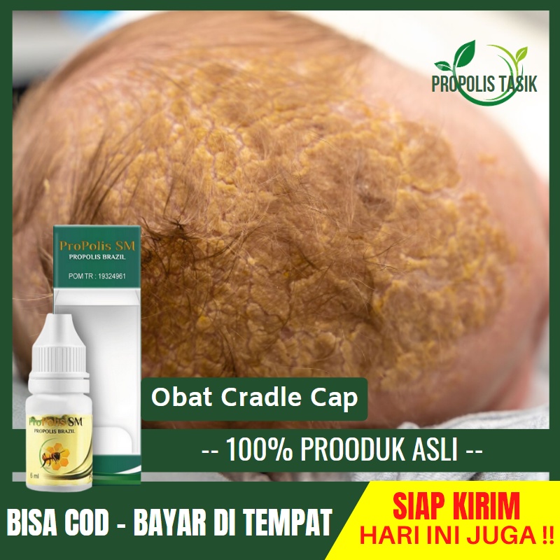 Jual Obat Cradle Cap Dermatitis Seboroik Kulit Kepala Berkerak Gatal