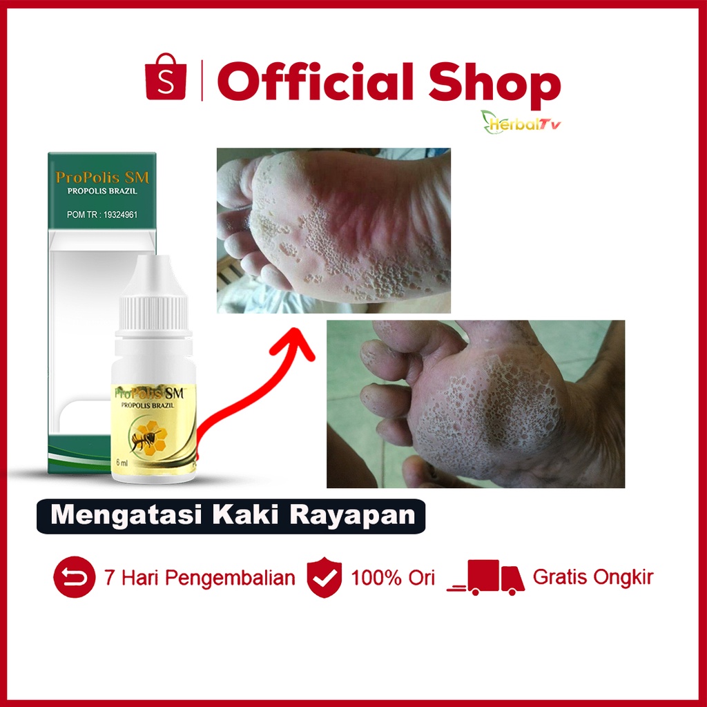 Jual Obat Kaki Rayapan Obat Kaki Pecah Dan Kering Telapak Kaki Bolong