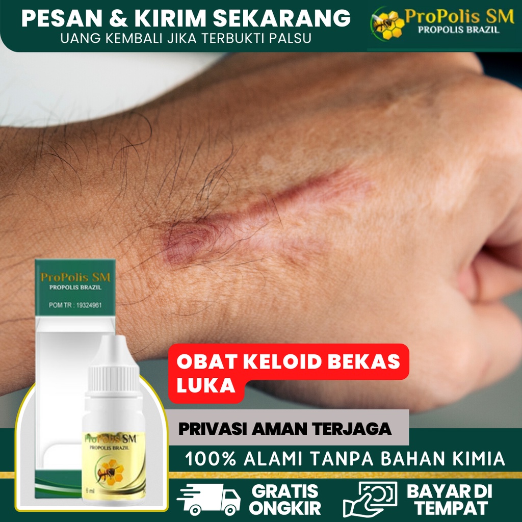 Jual Obat Keloid Daging Tumbuh Obat Keloid Injeksi Obat Keloid