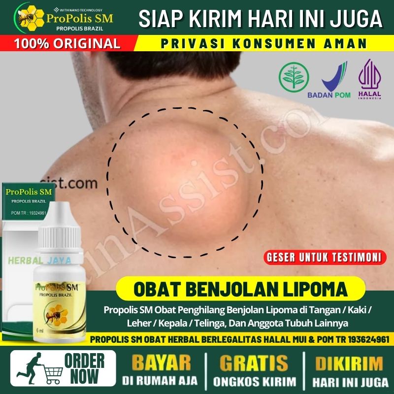 Jual Obat Oles Penghilang Lipoma Di Punggung Leher Kepala Dll