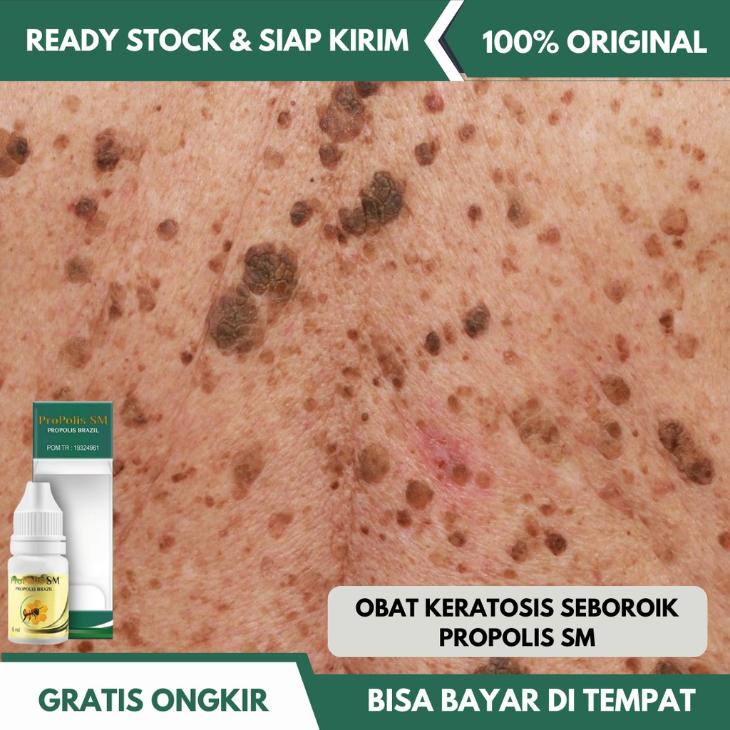 Jual Obat Keratosis Seboroik Penyakit Kulit Bintik Hitam Di Kulit